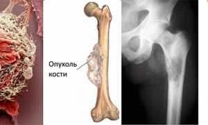 Каковы причины болей в бедре и как их устранить для улучшения качества жизни?