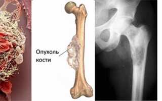 Каковы причины болей в бедре и как их устранить для улучшения качества жизни?