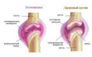 Как лечить остеоартроз суставов стопы? Полезные советы и рекомендации