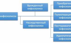 Степени и признаки кифосколиоза позвоночника: важные аспекты для понимания