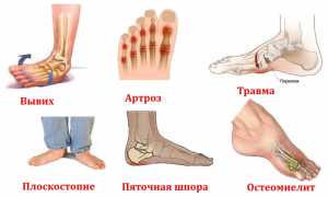Как проводят рентгенографию стопы и что она показывает? Полное руководство
