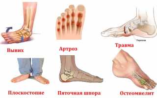 Как проводят рентгенографию стопы и что она показывает? Полное руководство