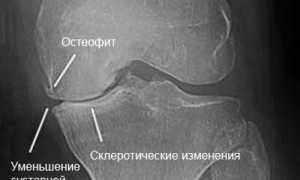 Лечение деформирующего артрита: методы и рекомендации