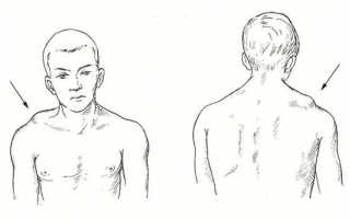 Первая помощь и лечебные меры при вывихе ключицы: советы и рекомендации