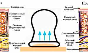 Массаж банками при остеохондрозе для улучшения здоровья
