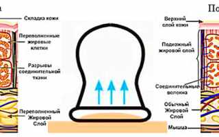 Массаж банками при остеохондрозе для улучшения здоровья