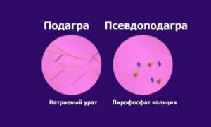 Что такое псевдоподагра и как ее лечить? Полное руководство