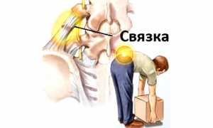 Лечение растяжения мышц спины в домашних условиях: советы и рекомендации
