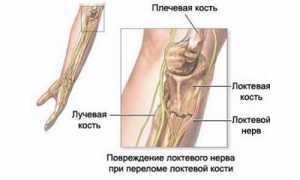 Причины и лечебные меры при ущемлении локтевого нерва: важные аспекты здоровья