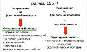 Можно ли вылечить сколиоз 4 степени без операции? Узнайте мнение специалистов