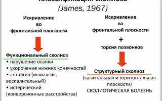 Признаки сколиотической деформации позвоночника у детей и взрослых