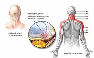 Симптомы и лечение шейного радикулита: полезные советы и рекомендации