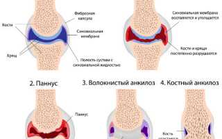 Дают ли пациенту инвалидность при ревматоидном артрите? Важные аспекты