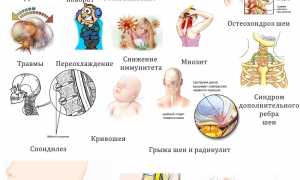Причины возникновения спазма мышц шеи и способы его лечения: полезные советы