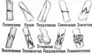 Как определить перелом мизинца на руке и чем его лечить? Полезные советы и рекомендации