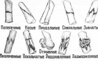 Как определить перелом мизинца на руке и чем его лечить? Полезные советы и рекомендации