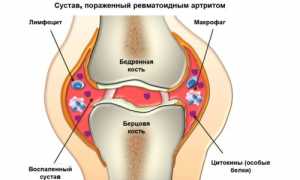 Особенности проявления дактилита и его лечение: важные аспекты и рекомендации