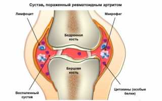 Особенности проявления дактилита и его лечение: важные аспекты и рекомендации