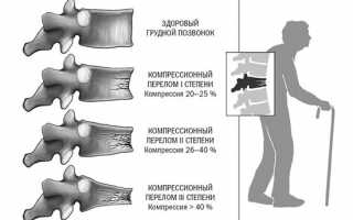 Признаки компрессионного перелома позвоночника и его лечение: важные аспекты здоровья