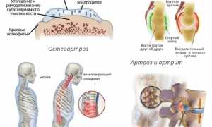 Чем можно заменить лекарственное средство Мелоксикам? Альтернативные варианты лечения