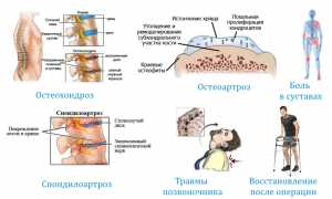 Применение лекарства Артифлекс при болезнях суставов и их лечении