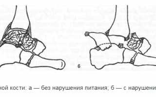 Признаки и методы лечения перелома таранной кости: советы и рекомендации
