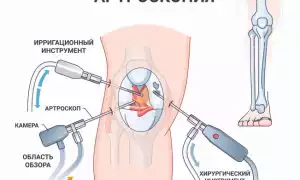 Артроскопия: показания к проведению лечения суставов