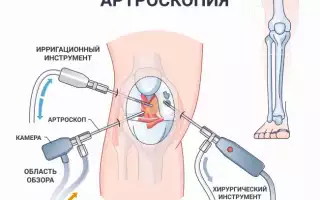 Артроскопия: показания к проведению лечения суставов
