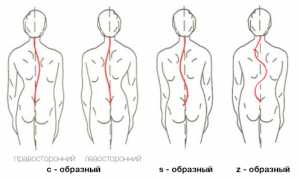 Как проявляется сколиоз позвоночника 1 степени у детей и взрослых?