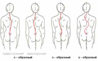 Проявление и способы лечения сколиоза 3 степени у взрослых