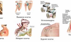 Обследование плечевого сустава с помощью МРТ для диагностики заболеваний