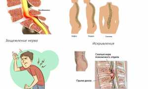 Эффективность применения тренажера для вытяжения позвоночника в реабилитации