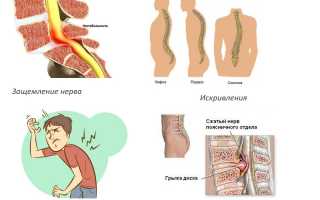 Эффективность применения тренажера для вытяжения позвоночника в реабилитации