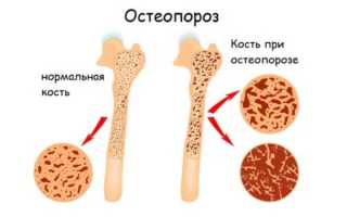 Использование лекарства Верокласт при остеопорозе для улучшения здоровья