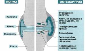 Диагностика генерализованного остеоартроза и его лечение: важные аспекты и рекомендации