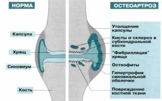 Диагностика генерализованного остеоартроза и его лечение: важные аспекты и рекомендации