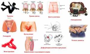 Почему болит в области копчика и что делать для облегчения?