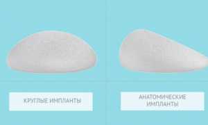 Отличия различных типов грудных имплантов: что нужно знать