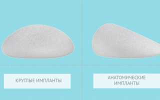Отличия различных типов грудных имплантов: что нужно знать