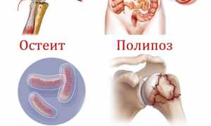Возможные причины появления саркомы плеча и ее лечение: важные аспекты