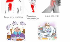 Препараты для лечения плечелопаточного периартрита: эффективные методы и рекомендации