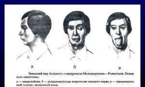 Признаки и последствия защемления лицевого нерва: важные аспекты здоровья