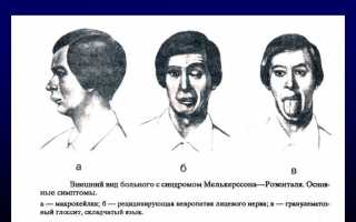 Признаки и последствия защемления лицевого нерва: важные аспекты здоровья