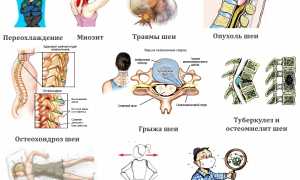 Что делать, когда болит шея при повороте головы? Полезные советы и рекомендации
