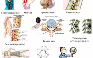 Выбираем какую мазь использовать при болях в шее: советы и рекомендации