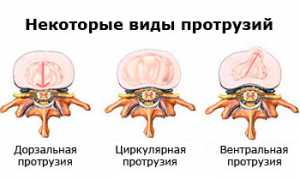 Циркулярные протрузии дисков позвоночника L3-L4, L4-L5, L5-S1: причины и лечение
