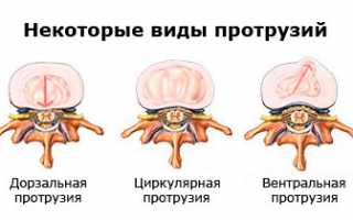 Циркулярные протрузии дисков позвоночника L3-L4, L4-L5, L5-S1: причины и лечение