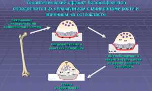Как применять Алендронат при лечении остеопороза для улучшения здоровья?