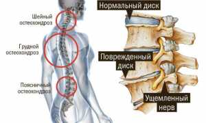 Можно ли заниматься спортом больным остеохондрозом для улучшения здоровья?