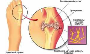 Совмещаются ли баня и подагра? Узнайте мнение специалистов